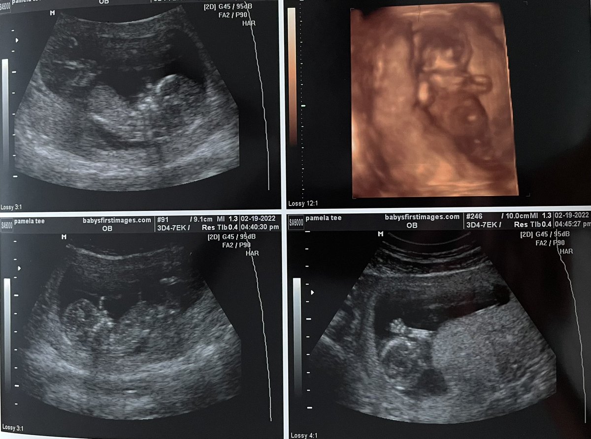 Baby Ambrose coming August 2022 💙💗