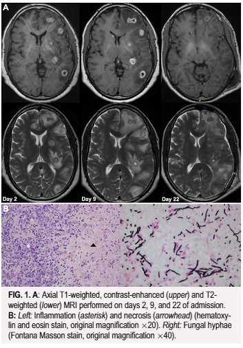 #JNSCaseLessons: An illustrative case demonstrating the utility of liquid biopsy in diagnosing isolated cerebral phaeohyphomycosis.
thejns.org/caselessons/vi…