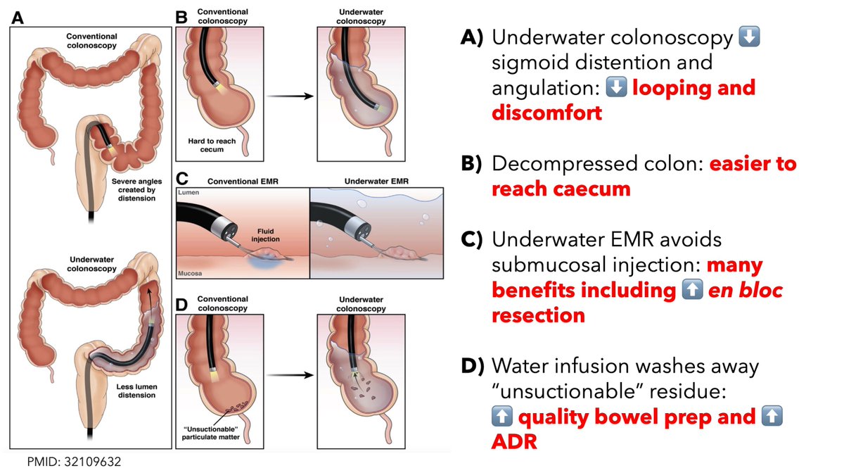 Underwater colonoscopy and EMR #GITwitter #4KMedEd