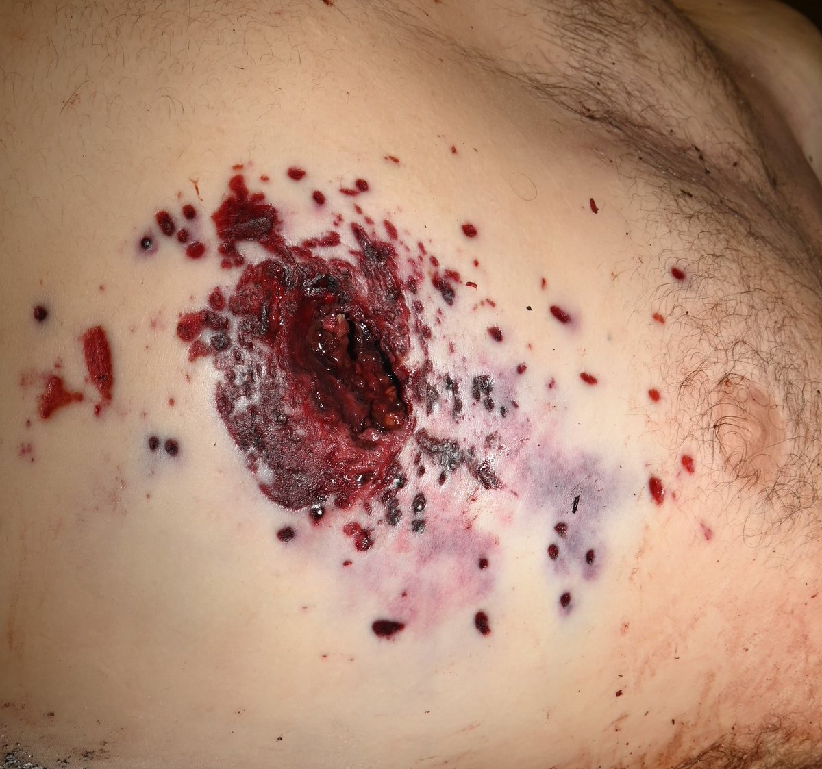 deadmendo's tweet photo. Photo follow-up for our #gunshotwound series: example of a #shotgun wound. Any guesses on range of fire? #ForensicPathology #PathTwitter https://t.co/bnUA6TMS4p