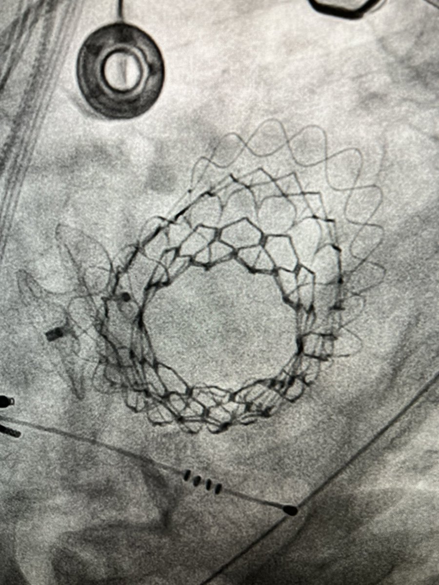 Dr. Gilbert Tang (@gilberttangmd) on Twitter photo 👏🏼 Big Milestone 1st 2 Intrepid TF #TMVR <a href="/MountSinaiNYC/">Mount Sinai Health System</a> <a href="/MountSinaiHeart/">Mount Sinai Fuster Heart Hospital</a> crossing 350th implant 🌎. Game changer vs TA. Congrats on our amazing team #DavidHAdams #SaminKSharma <a href="/KHERA_MD/">Sahil Khera</a> #MenachemWeiner #StamLerakis <a href="/MDT_StructHeart/">Medtronic Structural Heart</a> team for A+ support. <a href="/dranulala/">Anu Lala-Trindade</a> <a href="/NoahMossMD/">Noah Moss</a> 👏🏼 Big Milestone 1st 2 Intrepid TF #TMVR <a href="/MountSinaiNYC/">Mount Sinai Health System</a> <a href="/MountSinaiHeart/">Mount Sinai Fuster Heart Hospital</a> crossing 350th implant 🌎. Game changer vs TA. Congrats on our amazing team #DavidHAdams #SaminKSharma <a href="/KHERA_MD/">Sahil Khera</a> #MenachemWeiner #StamLerakis <a href="/MDT_StructHeart/">Medtronic Structural Heart</a> team for A+ support. <a href="/dranulala/">Anu Lala-Trindade</a> <a href="/NoahMossMD/">Noah Moss</a>