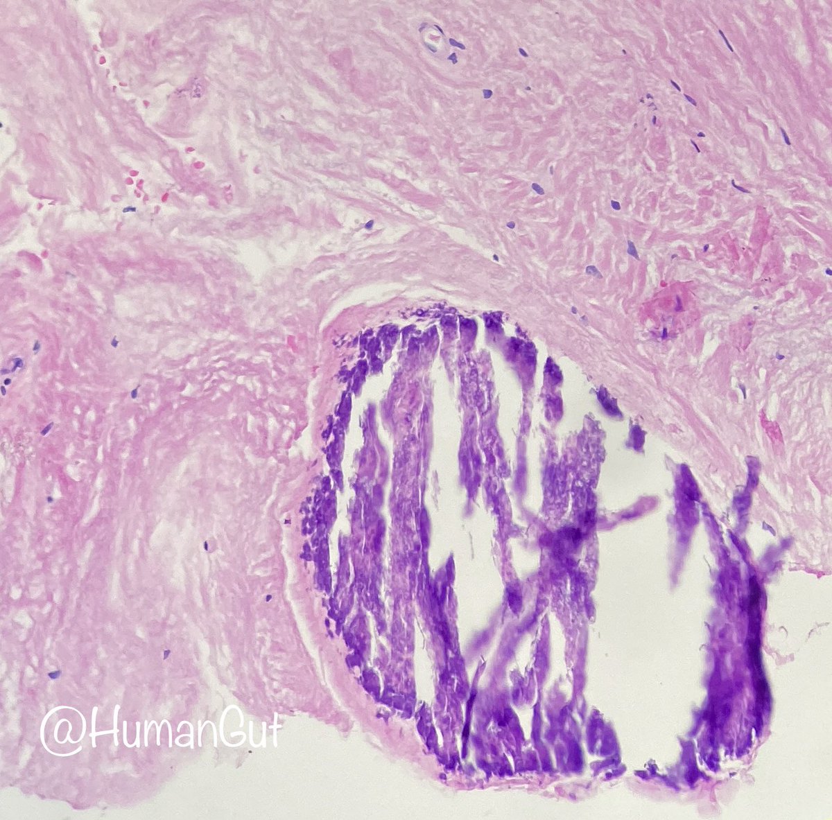 Hemangioma with degenerative changes