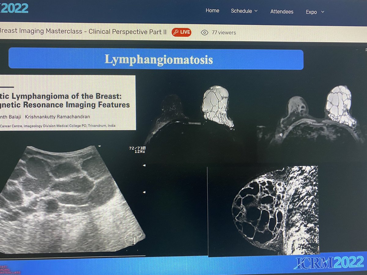 Breast_Master's tweet photo. Interesting talk by Dr. Sara Alsultan: size discrepancy of: imaging perspective @NKhoumais @shaza_alsharif #ICRM2022 @radmed_ICRM https://t.co/WfSFS4FicT