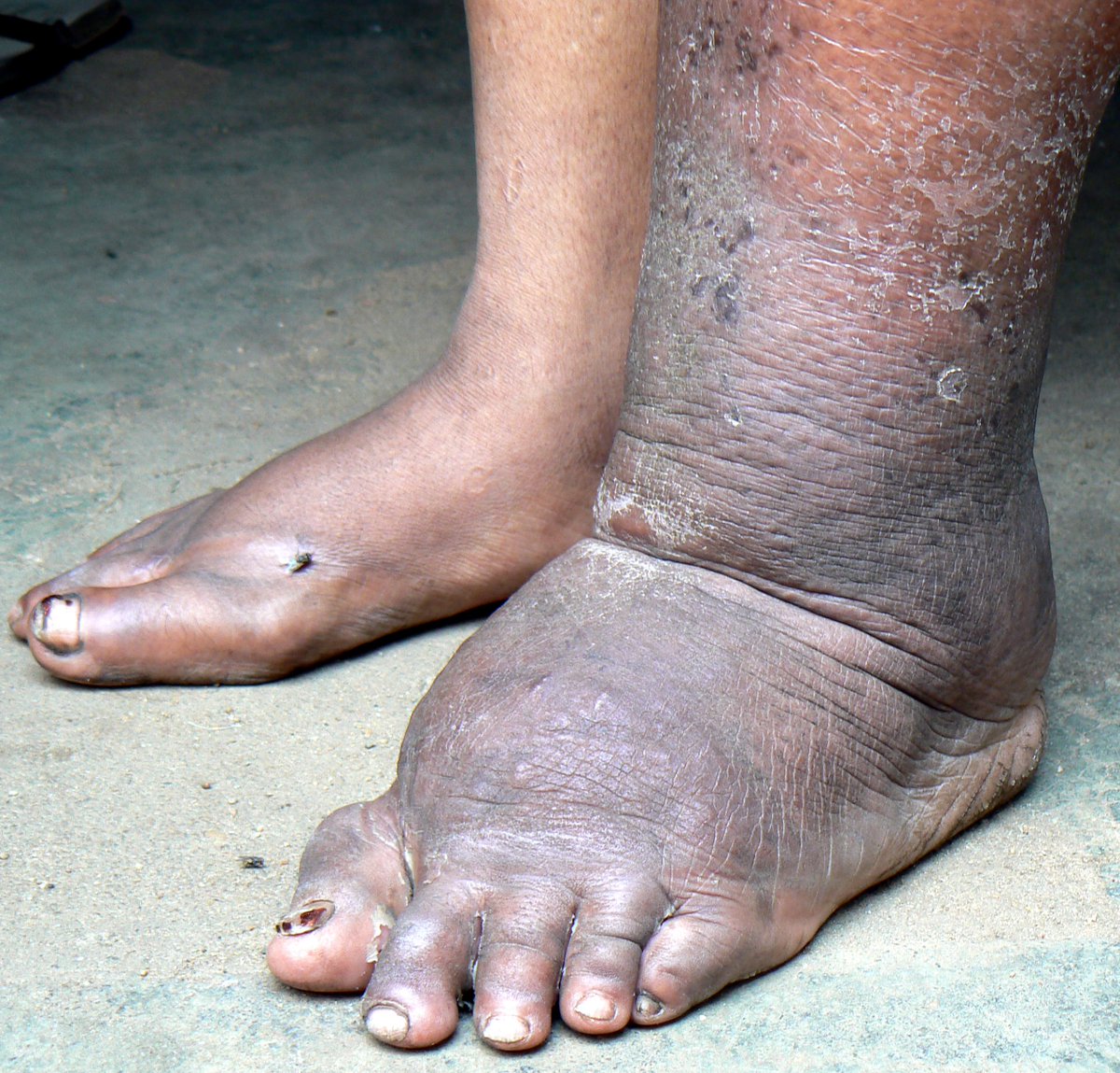jcomls's tweet photo. Neglected Tropical Disease 
Elephantiasis https://t.co/SaQ9USnDtO