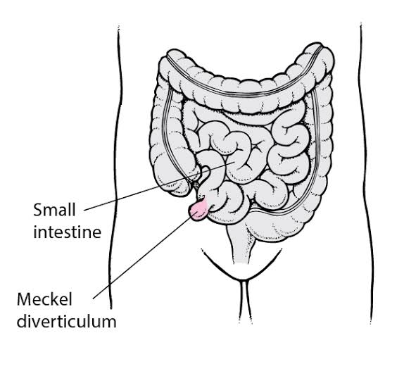 MedicalMnemonik's tweet photo. Topic: Clinical Anatomy
Sub-topic: Meckel diverticulum
Rule of 2s of Meckel diverticulum
ILEUM
2 feet from the #Ileocecal value
2 inches in #Length
2 #Ectopic tissue (gastric/pancreatic)
2 #Undoubted (symptomatic)
2 ร commoner in #Men https://t.co/TrfUpj0bQq