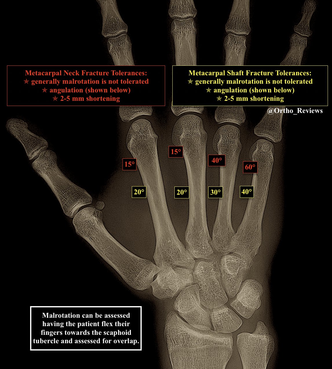 Metacarpal Neck