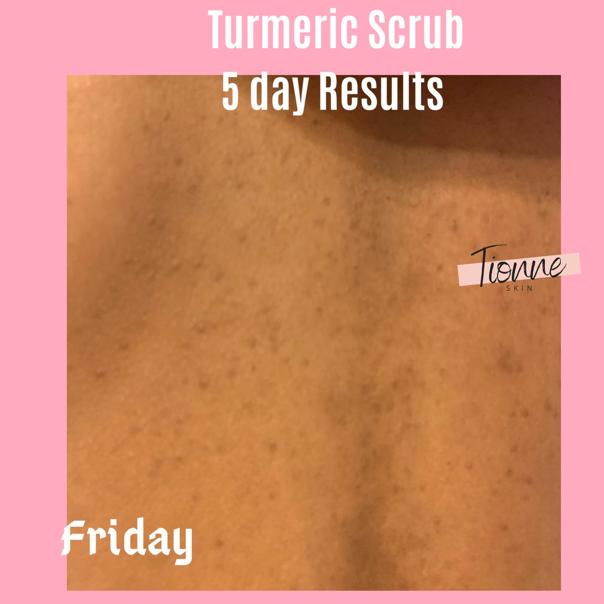 tionneskin's tweet photo. Turmeric Brightening Scrub should be used 2-3X a week so your skin can glow, and have a brighter complexion 

It can be used to fade scars, fade dark spots, reduce hyperpigmentation, even out your skin tone, and it reduces discoloration 

Pair it with my Turmeric Soap https://t.co/yVmbJY51JK