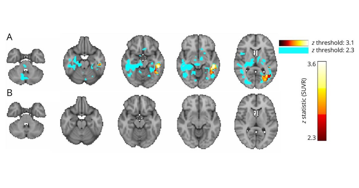 GreenJournal's tweet photo. This study casts a new light onto the role of neuroinflammation and related microstructural alterations of #HIV infection in the CNS and shows that elite controllers suppress #neuroinflammation more effectively than people with HIV on therapy. Learn more: https://t.co/d9MKpJbROF https://t.co/zULZvIYvlP