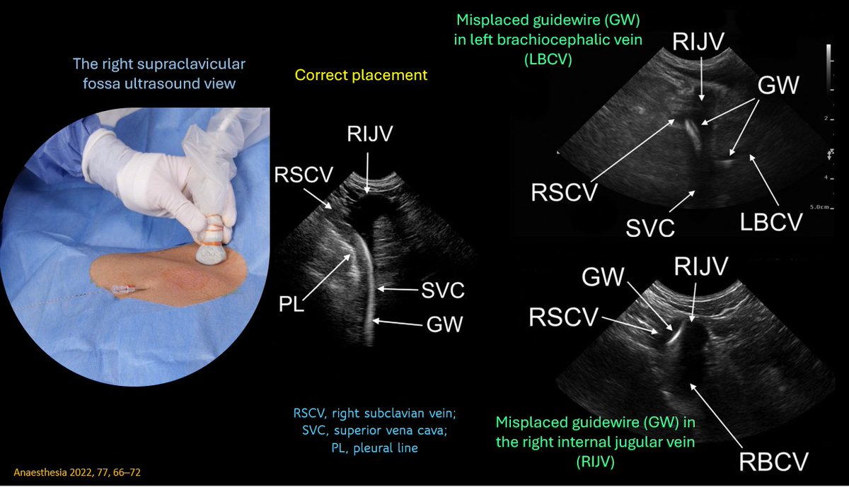 NephroP's tweet photo. Right supraclavicular fossa #POCUS view for correct guidewire positioning during right subclavian vein catheterization. Kind of continuation of my yesterday's IJ catheter case.
#MedEd #Nephrology #IMPOCUS 
🔗https://t.co/pCtwUmI9Jl https://t.co/5v7EfvvEA2