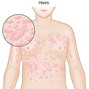 Hives (urticaria) is a skin rash triggered by a reaction to food, medicine or other irritants. Hives is a common skin rash triggered by many things, including certain foods, medication and stress.
#hives #immunology #urticaria #iching #redness #inflamation #skinallergy