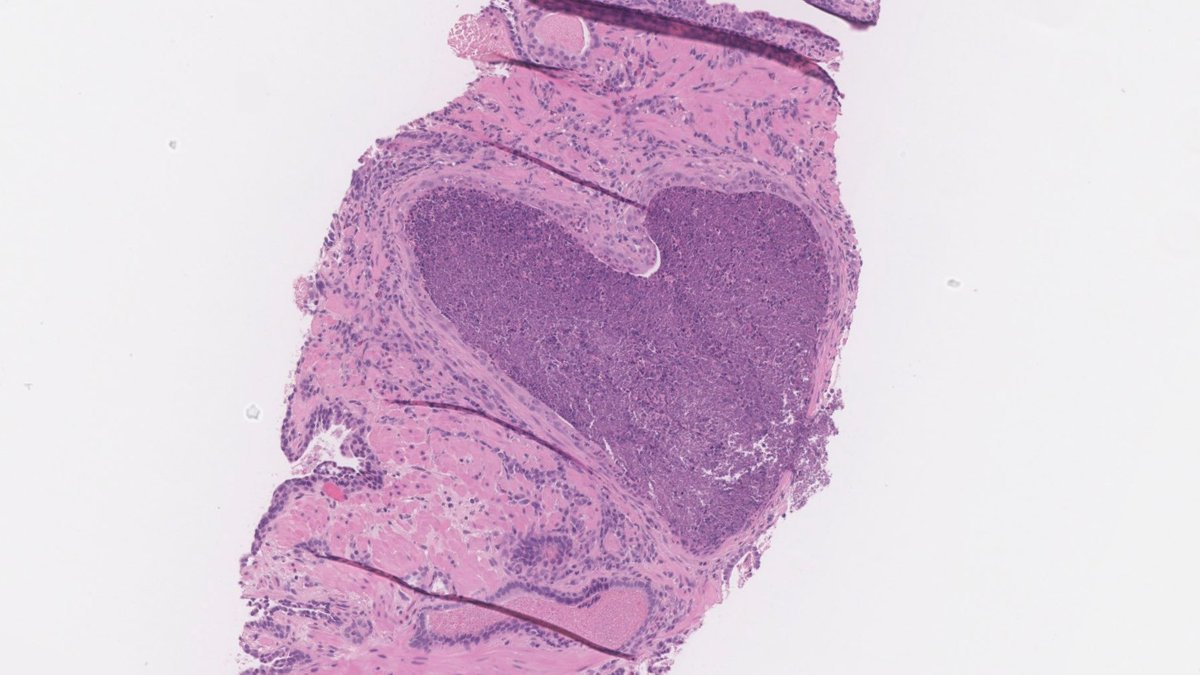 Carol Cheung, MD, PhD, JD (@drcarolcheung) on Twitter photo #HappyValentinesDay 💝
#pathart #gupath
<a href="/SammyBytes/">Sammy Lawrence</a> <a href="/abstractica/">Dr. Elle, HCM 👑👻 not much here, but sometimes</a> @kathymahar #HappyValentinesDay 💝
#pathart #gupath
<a href="/SammyBytes/">Sammy Lawrence</a> <a href="/abstractica/">Dr. Elle, HCM 👑👻 not much here, but sometimes</a> @kathymahar
