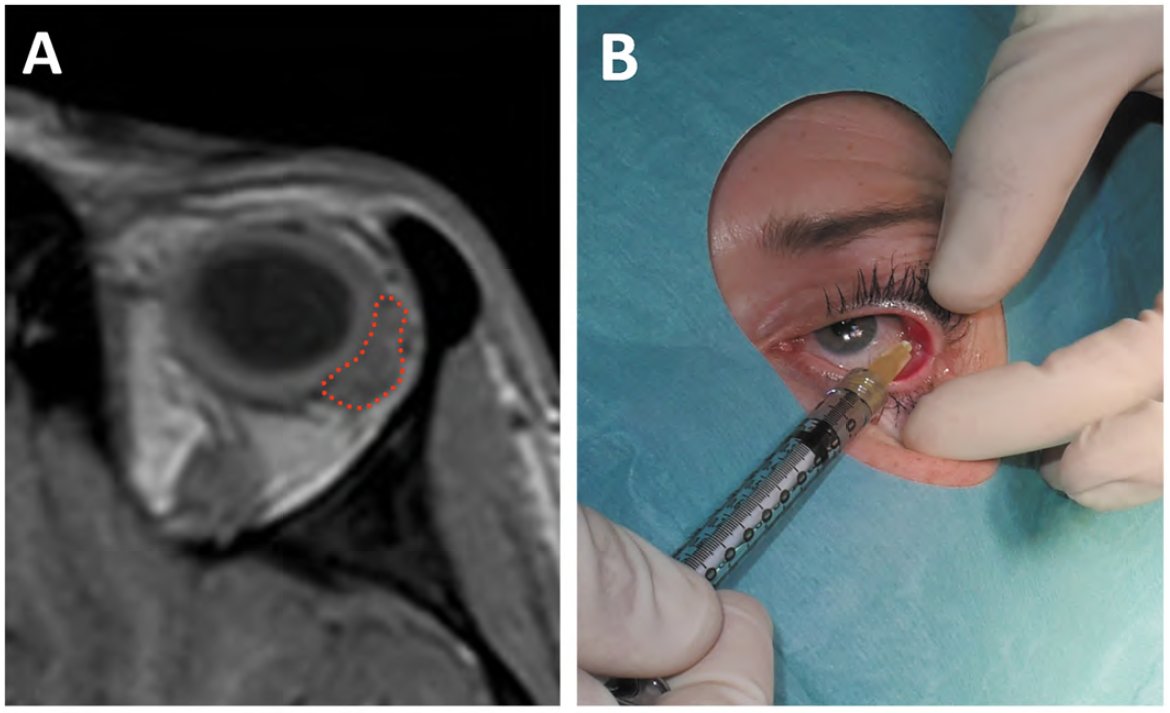 Early trials highlight promise of stem cells in treating dry eye disease <a href="/eurotimes/">EuroTimes</a> report from ESCRS in Amsterdam.
ow.ly/SsaF50HT3lX