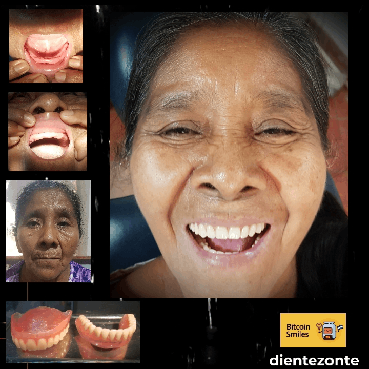 BitcoinSmiles's tweet photo. Case #14 - Guillerma is a 66yo mother of six and a housewife.  She has been 40 years without teeth and dental care access. Once she saw her finished prosthesis, Guilerrma burst into tears with her new smile.
#BitcoinFixesTeeth https://t.co/BErAzjA12t