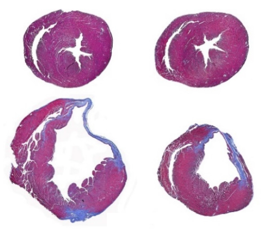GeneTherapy_SN's tweet photo. Online now out of @Stanford and @univmiami, #AAV9 assisted delivery of mAKAP-targeted #shRNA prevents cardiac remodeling, #heartfailure and restores the LVEF in an ischemic cardiomyopathy animal model. #GTArticle here➡️ https://t.co/tWLBF5708h
📸: Stained MI heart sections https://t.co/pBRnwdcx2B