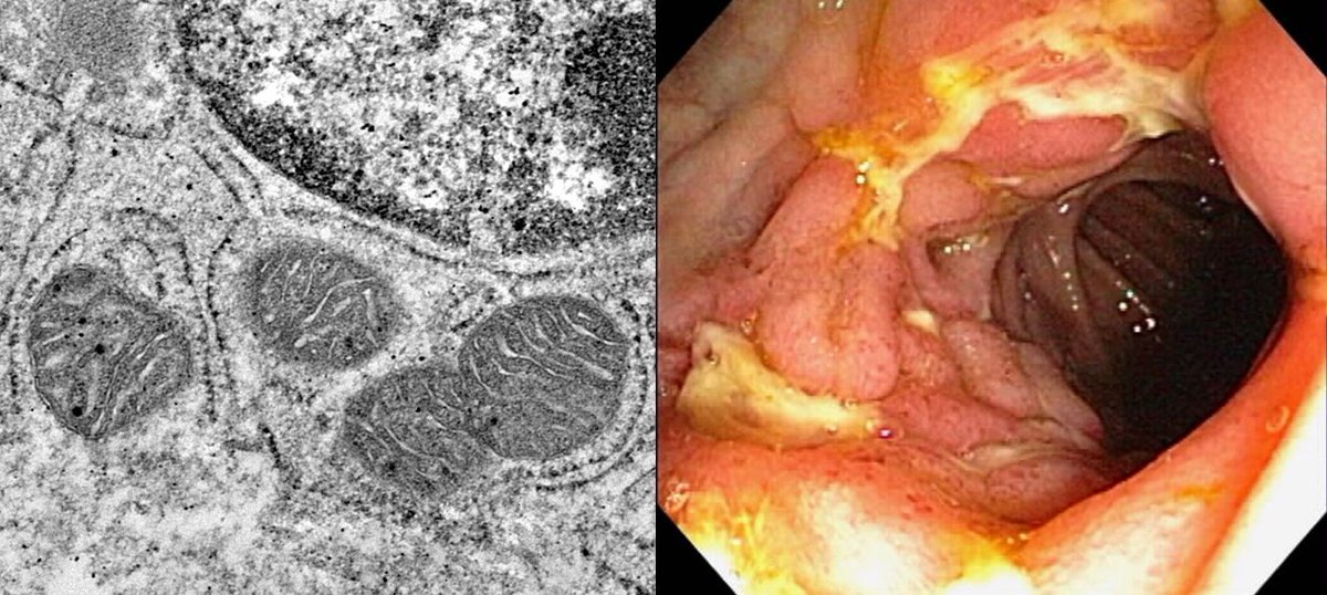 Gwo Tzer (@gwotzerho) on Twitter photo Ever wonder about the importance of #mitochondria in #crohns #UC #IBD? Fantastic to work with <a href="/arianne_theiss/">Arianne Theiss</a> - Mitochondria and IBD: Toward a Stratified Therapeutic Intervention
Finally out in Annual Review of Physiology <a href="/AnnualReviews/">Annual Reviews</a> #clinicaltrials
edin.ac/3HNYeeV Ever wonder about the importance of #mitochondria in #crohns #UC #IBD? Fantastic to work with <a href="/arianne_theiss/">Arianne Theiss</a> - Mitochondria and IBD: Toward a Stratified Therapeutic Intervention
Finally out in Annual Review of Physiology <a href="/AnnualReviews/">Annual Reviews</a> #clinicaltrials
edin.ac/3HNYeeV