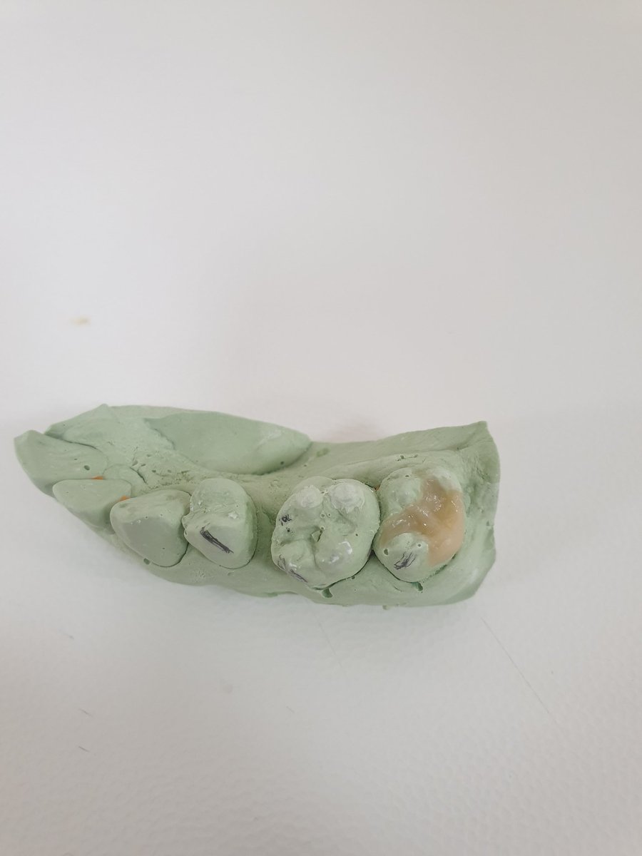 Indirect onlay (build up)

تجربة جميلة