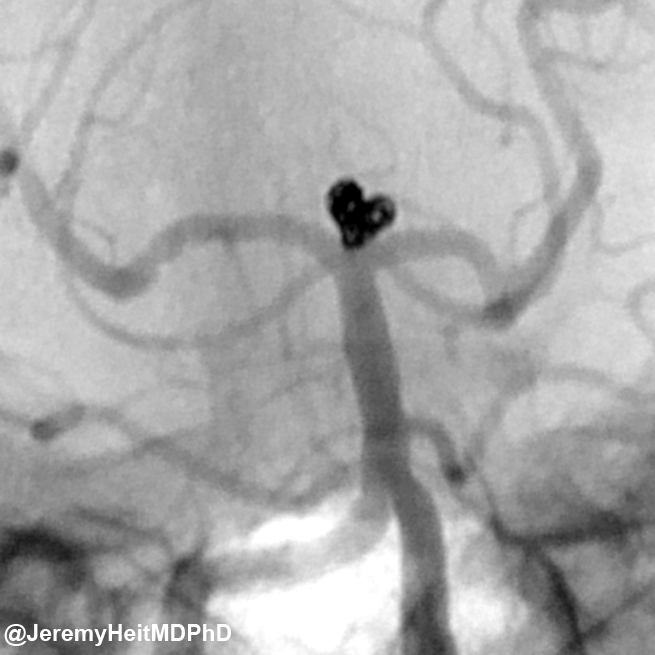JeremyHeitMDPHD's tweet photo. Nothing says “I love you” like a neurointerventional surgeon fixing a broken basilar aneurysm. Happy Valentine’s Day! @Stanford_Neuro #stroke https://t.co/KiKuW9SNdY