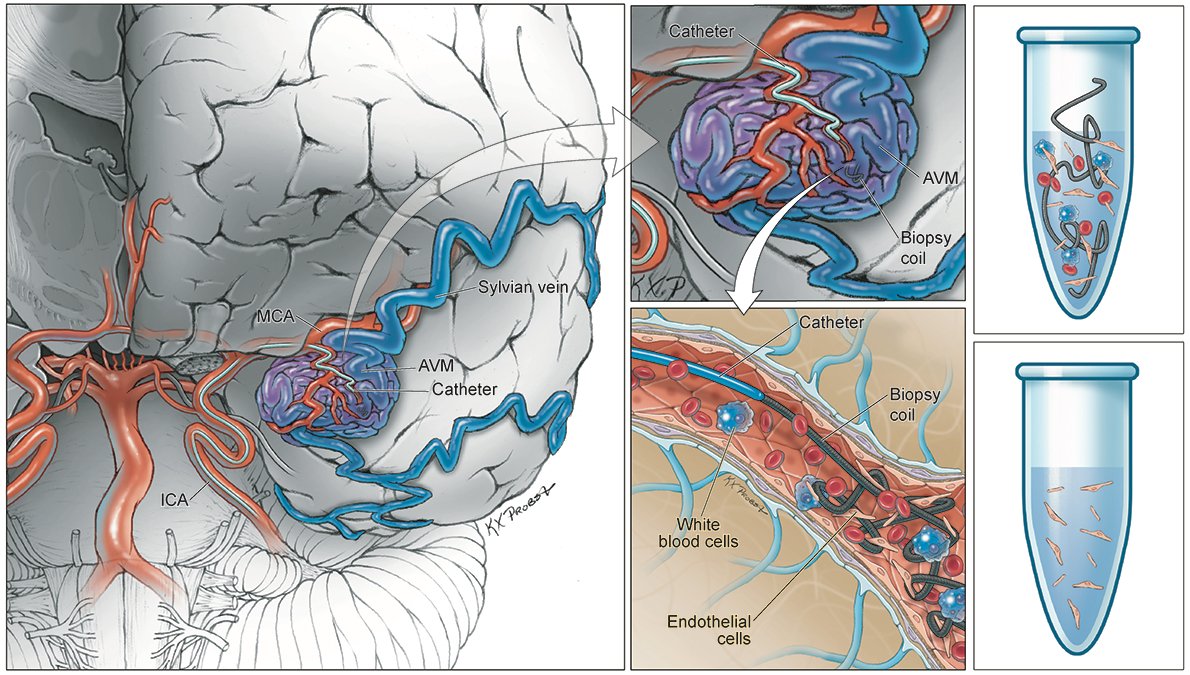 Thrilled to share our work in <a href="/GreenJournal/">Neurology Journal</a> describing endovascular biopsy to allow molecular classification of AVMs in living patients. Beautiful collaboration <a href="/UCSF/">UC San Francisco</a> between <a href="/NeurosurgUCSF/">UCSF Neurosurgery</a> &amp; <a href="/UCSF_NIR/">UCSF Neuroendovascular Surgery</a>. @barrowNeuro <a href="/TAAF/">The Aneurysm and AVM Foundation (TAAF)</a> <a href="/taaf4kids/">TAAF 4 Kids</a> bit.ly/3sCq47B