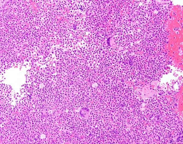 BWHPath's tweet photo. Patient with slow-growing, cavitary lung mass and dime-sized rim-enhancing brain lesion. The specimen shown below is an endobronchial lung biopsy. What is the diagnosis? #BWHPathCotW #IDpath #Pathology #Cytopath 1/ https://t.co/VBYhX51HMJ