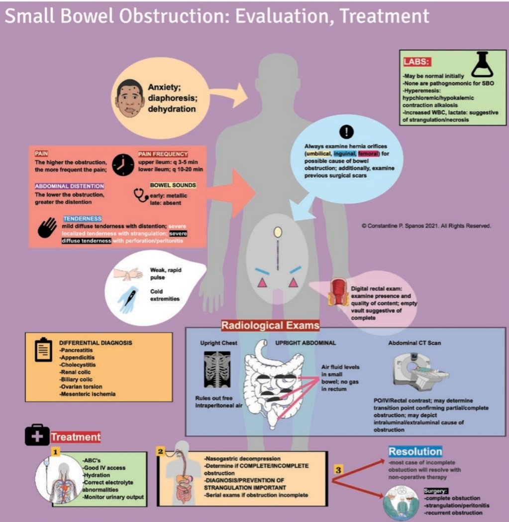 DRAFTABAHMED7's tweet photo. Bowel Obstruction:
𝗥𝗲𝗳:Acute Surgical Topics,  An Infographic Guide, 2021
#Obstruction 
#GITwitter #MedTwitter #ischemia #gangrene 
#exploratorylaparotomy https://t.co/6J8r9g5LPN