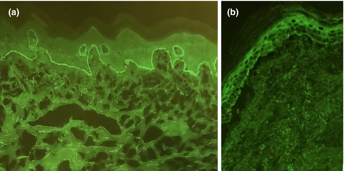 Pediatric on Squares on X: Rubinstein Taybi Syndrome #Pediatric