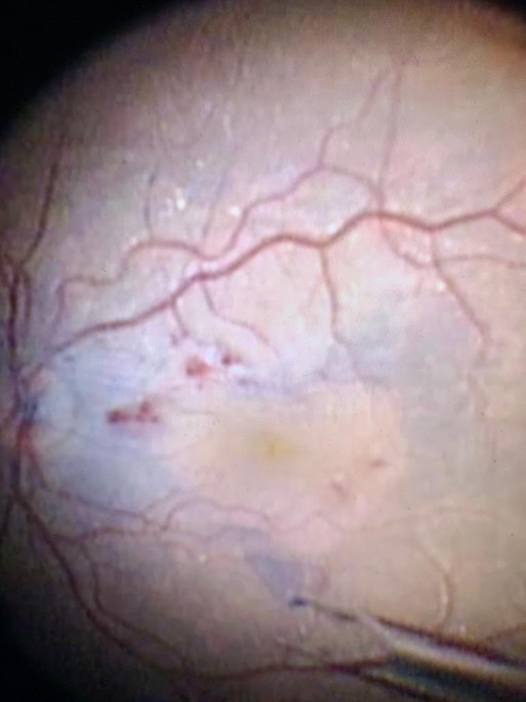 Happy Valentines from the peeled macula!