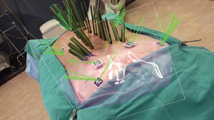 KarsyMichael's tweet photo. Our recently published paper in Spine showing the great accuracy of augmented reality guided pedicle screw placement (https://t.co/YjyEBM5Jjh). #uofuneurosurgery #spine #augmentedreality #novarad https://t.co/IOCdCBMg1W