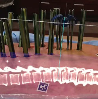 KarsyMichael's tweet photo. Our recently published paper in Spine showing the great accuracy of augmented reality guided pedicle screw placement (https://t.co/YjyEBM5Jjh). #uofuneurosurgery #spine #augmentedreality #novarad https://t.co/IOCdCBMg1W