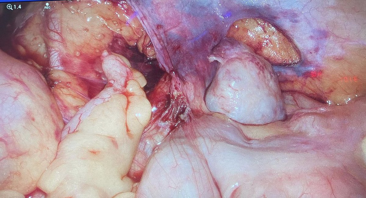 Marta Pascual (@martapascual_md) on Twitter photo Today, laparoscopic ovarian transposition in a young lady with rectal cancer previous to neoadyuvant treatment…not only oncological outcomes matters. <a href="/hospitaldelmar/">Hospital del Mar</a> <a href="/solesedeno/">JosepM SoleSedenoMD</a> <a href="/ccr_hmar/">CCR HOSPITAL DEL MAR</a> <a href="/AECP_FAECP/">AECP</a> <a href="/escp_tweets/">European Society of Coloproctology</a> Today, laparoscopic ovarian transposition in a young lady with rectal cancer previous to neoadyuvant treatment…not only oncological outcomes matters. <a href="/hospitaldelmar/">Hospital del Mar</a> <a href="/solesedeno/">JosepM SoleSedenoMD</a> <a href="/ccr_hmar/">CCR HOSPITAL DEL MAR</a> <a href="/AECP_FAECP/">AECP</a> <a href="/escp_tweets/">European Society of Coloproctology</a>