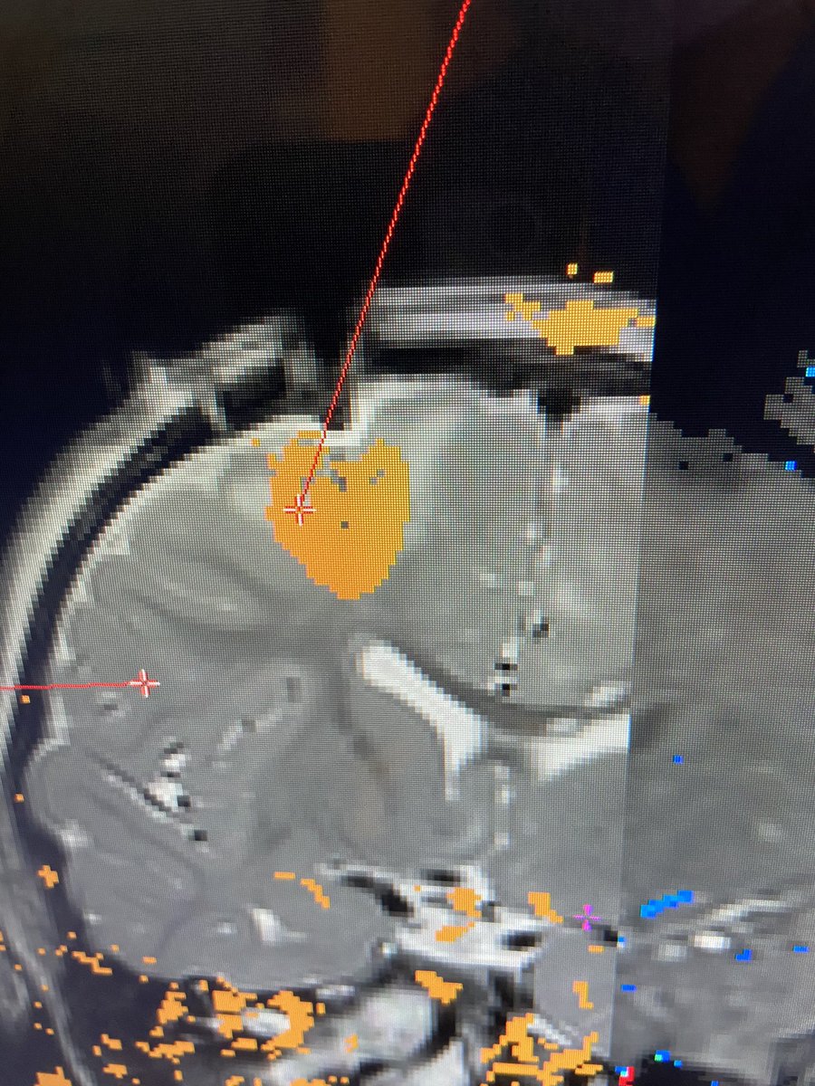 adelawu's tweet photo. In honor of Valentine’s Day, a ♥️-shaped laser ablation area during treatment for a patient with tuberous sclerosis. #Neurosurgery #MedTwitter https://t.co/ky8Eeg0Pji
