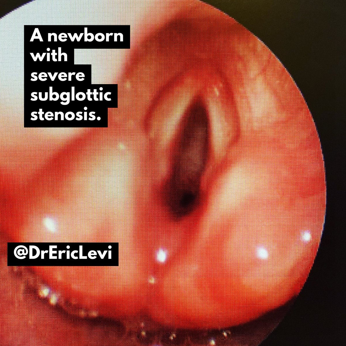 DrEricLevi's tweet photo. The vocal folds looks normal and well spaced. But look in the distance. There’s a small pinpoint opening to the trachea. This is severe subglottic stenosis. An airway emergency. We can reconstruct this voice box by expanding it with a cartilage graft taken from a rib. #ENTtips https://t.co/XGC2Z0r51N
