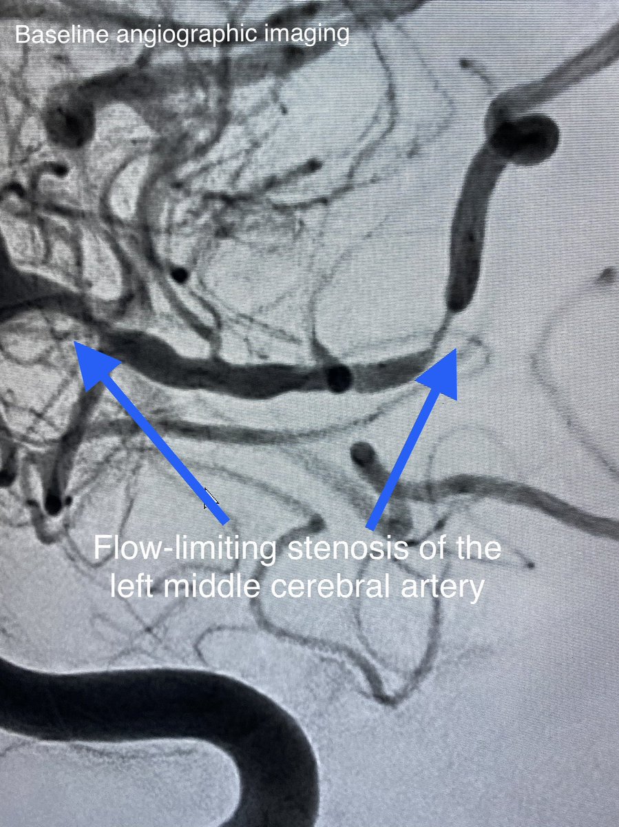 VascNeuro's tweet photo. 78M presents with LT hemispheric stroke w/ flow-limiting, pressure dependent left M1 and M2 stenosis treated with Wingspan &amp; Gateways. Patient with no deficits post op. #NeuroIR #MedEd #neuroscience #neurology https://t.co/6A9sEo5sW8