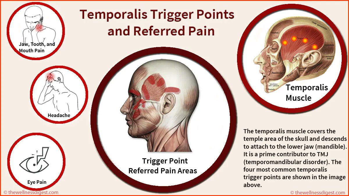 thewelldigest's tweet photo. Headaches in the temple area and side of the head, pain above the eye, and painful, sensitive upper teeth are symptoms of trigger points and an overly tight temporalis muscle. The muscle is involved with TMJ, Temporomandibular joint dysfunction.
https://t.co/AnpYkkvup0 https://t.co/3Z5Ro9qU7B