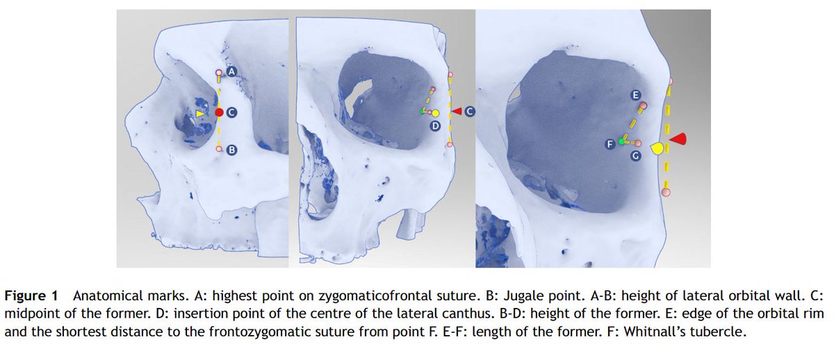 IntegProsRecon's tweet image. Searching for an alternative way of identifying the insertion of the lateral canthus for the use of #bionicimplants, this study explores the #anatomy of the #lateralorbitalwall and shows its height can be reliably used!

#WhitnallsTubercle @JPRASurg 
 sciencedirect.com/science/articl…