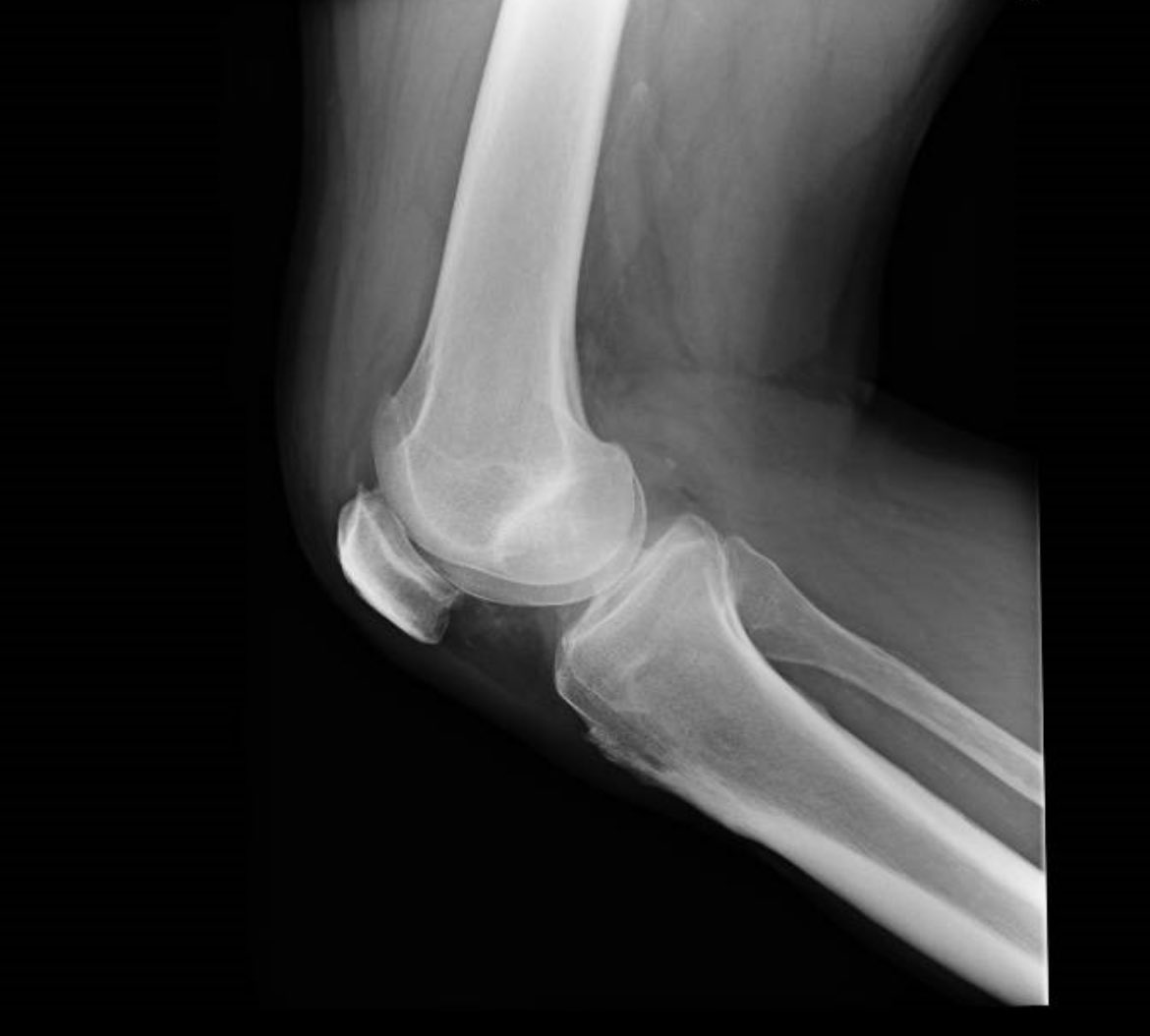 draulrikita's tweet photo. Paciente varón de 52 años al que se realiza rx y ecografía de rodilla por dolor. Las imágenes eco corresponden a tróclea femoral e inserción del tendón poplíteo en CFE. Hallazgos?diagnóstico? @MskSerme https://t.co/klJe0jI2Es