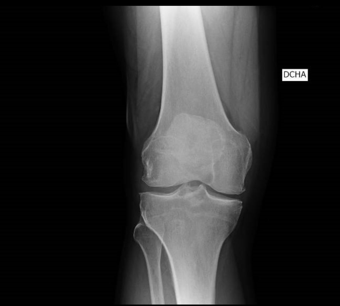 draulrikita's tweet photo. Paciente varón de 52 años al que se realiza rx y ecografía de rodilla por dolor. Las imágenes eco corresponden a tróclea femoral e inserción del tendón poplíteo en CFE. Hallazgos?diagnóstico? @MskSerme https://t.co/klJe0jI2Es