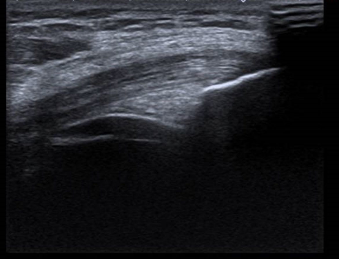 draulrikita's tweet photo. Paciente varón de 52 años al que se realiza rx y ecografía de rodilla por dolor. Las imágenes eco corresponden a tróclea femoral e inserción del tendón poplíteo en CFE. Hallazgos?diagnóstico? @MskSerme https://t.co/klJe0jI2Es