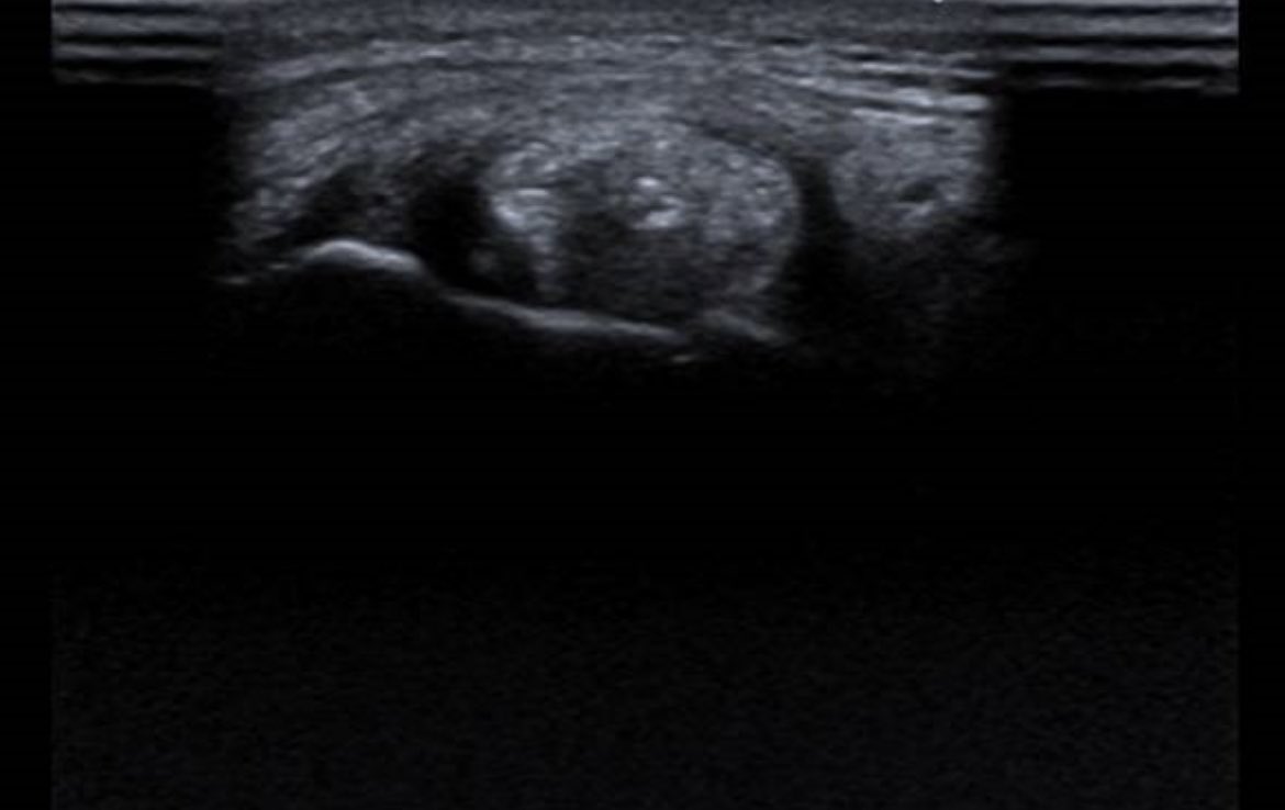 draulrikita's tweet photo. Paciente varón de 52 años al que se realiza rx y ecografía de rodilla por dolor. Las imágenes eco corresponden a tróclea femoral e inserción del tendón poplíteo en CFE. Hallazgos?diagnóstico? @MskSerme https://t.co/klJe0jI2Es