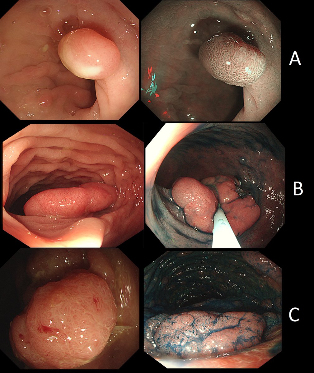 Here are three colonic polyps. One is a TA+LGD, another a TA+HGD and one is a TVA...
WHICH POLYP IS THE TVA?
a) A
a) B
c) C

Of course, for the impatient there is an instant 'reveal' 🙂 at our 'image library website'    friendsofendoscopy.org
