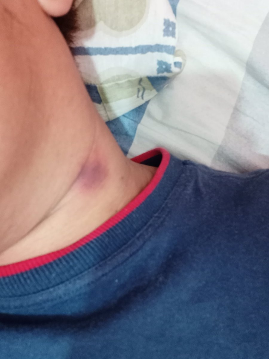kuya_js's tweet photo. Ang laking lamok naman... https://t.co/JoaUbRzESt