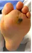 DiabeticFootCa's tweet photo. When it comes to diabetic foot ulcers, primary healing is only half the battle. High recurrence rates underscore the need to continue preventive measures. #Savethe4 #EndAmputations
https://t.co/2CEvMh6C5e https://t.co/QcVAihECNt