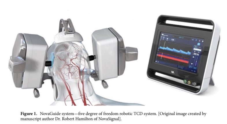Eric Feldstein (@eric_feldstein) on Twitter photo Analysis of 48 patients in a safety/ efficacy study of the NovaGuide robotic TCD for the measurement of cerebral blood flow velocities in vasospasm screening post-
SAH showed 0 negative outcomes and significant agreement with CT angiography (K=0.74)
<a href="/almuftifawaz/">Fawaz Al-Mufti, MD, FSVIN</a>
<a href="/nymcbrainspine/">Westchester Medical Center Neurosurgery</a> Analysis of 48 patients in a safety/ efficacy study of the NovaGuide robotic TCD for the measurement of cerebral blood flow velocities in vasospasm screening post-
SAH showed 0 negative outcomes and significant agreement with CT angiography (K=0.74)
<a href="/almuftifawaz/">Fawaz Al-Mufti, MD, FSVIN</a>
<a href="/nymcbrainspine/">Westchester Medical Center Neurosurgery</a>