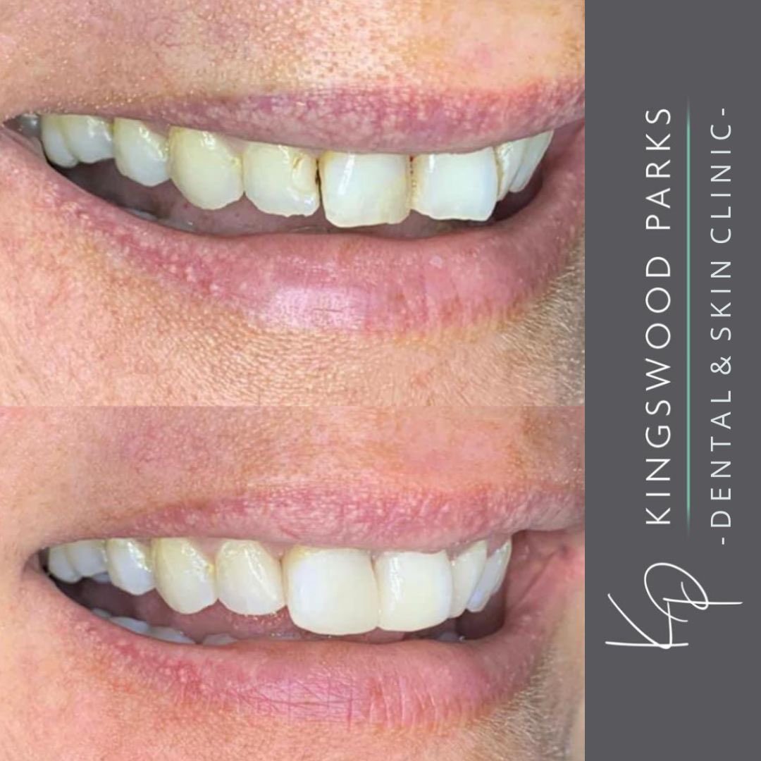 KPClinics's tweet photo. Filling Replacement ONLY 🙌🤯 #compositeveneers #beforeandafter #filling #clinicalwork #composite #teeth #dentalclinic #dentist https://t.co/l9KXDLIVMg