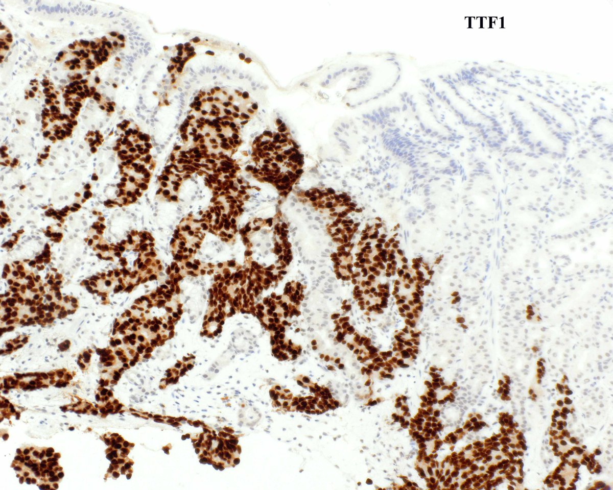 Good gosh - I initially mistook this for a rare gastric carcinoma with peculiar oxyntic/parietal cell differentiation.  Gulp.  Thankfully I realized my error in a reasonable time frame.