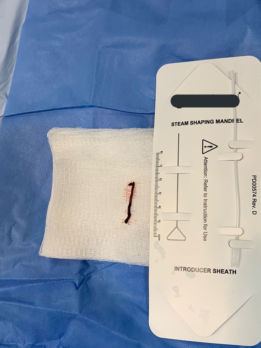 MediCasos's tweet photo. IMAGEN DE HOY |

Infarto de arteria basilar con terapia endovascular se obtiene coágulo. 

El tamaño: https://t.co/uEONYjsVCW