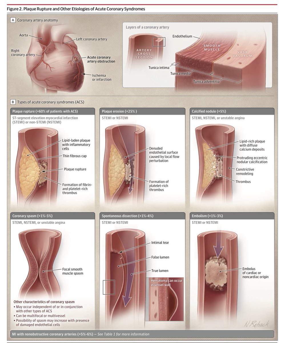 Juli0BS's tweet photo. 〽️Tipos de Síndrome coronario agudo y terapias farmacológicas a implementar

📚JAMA (2022) February 15, 2022 Volume 327, Number 7 https://t.co/wvTYUjes7b