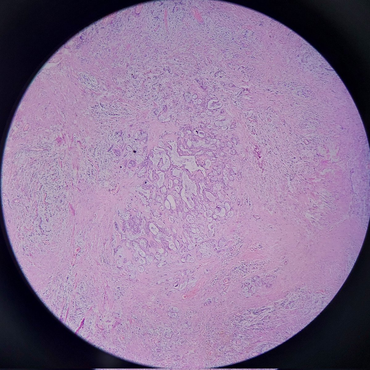 ViralBhanvadia's tweet photo. Middle age female,solid cystic mass in superio temporal orbit,Who am I??#eyepath, #headandneckpath #pathboard #pathresident #headneckpathology https://t.co/Hh8tKtFMsR