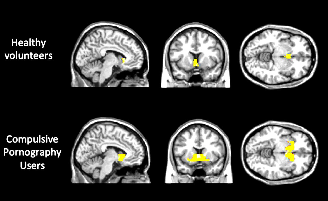 SpartanPsyche's tweet image. Chronic Porn abuse is causing erectile dysfunction in men as young as 17 years of age..
Millennials struggle with lowest libido in 60 years, PIED, fried dopamine receptors..all from porn abuse.
Follow this STEP BY STEP strategy to
QUIT TODAY, with ZERO relapse.
Thread /