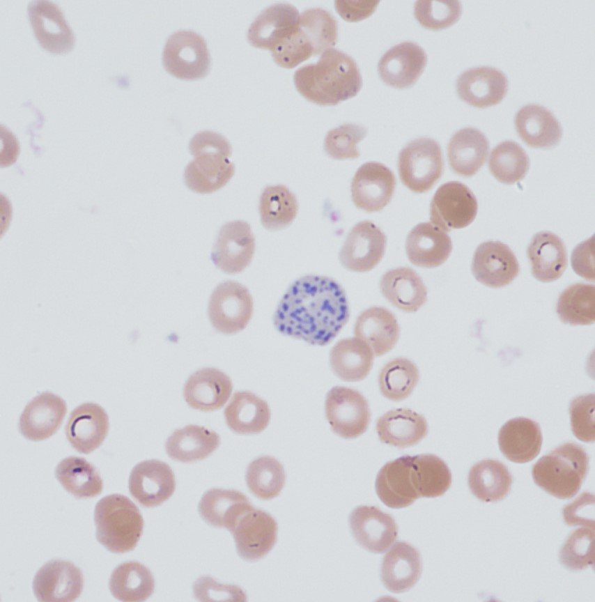 Promyelocyte13's tweet photo. Beautiful coarse RBC stippling & Neutrophil hypersegmentation in a severely folate deficient patient https://t.co/3uNfuD6FEJ