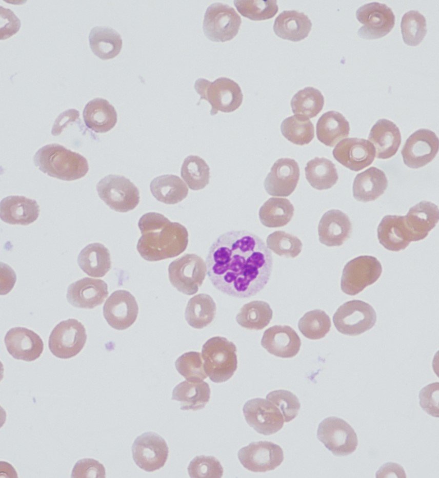 Promyelocyte13's tweet photo. Beautiful coarse RBC stippling & Neutrophil hypersegmentation in a severely folate deficient patient https://t.co/3uNfuD6FEJ
